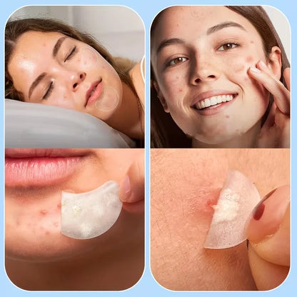 Large Pimple Patches for Face, Hydrocolloid Acne Patches, Variety Shapes Zit Covers, Moon, Strip, Square, Rectangle, Nose Strip