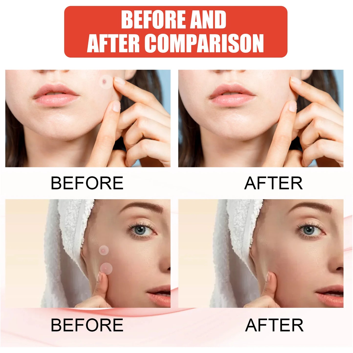 144pcs Face Acne Patch Invisible Skin Care Pimple Acne Patches Anti-inflammatory Healing Absorbing Spot Sticker Covering Acne